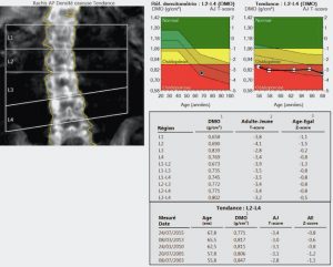 ostéodensitométrie